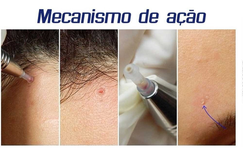 Imagem 3 de 4 de Caneta Face Clean Para Limpeza De Pele Sem Dor 50 Ponteiras
