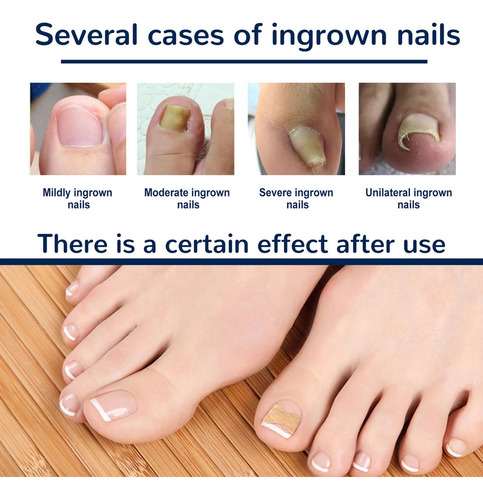 Mox Parche Corrector De Uñas De Los Pies, Parche Reparador