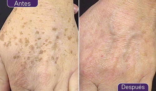 Crema Blanqueadora Para Despigmentar La Piel Benoquin Neutra