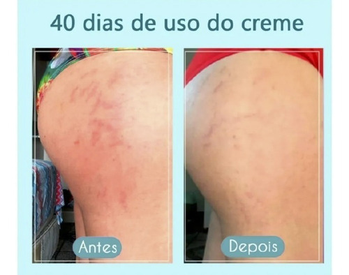 Imagem 5 de 10 de Kit Creme Cicatribem 150g + Esfoliante 120g Tira Estrias