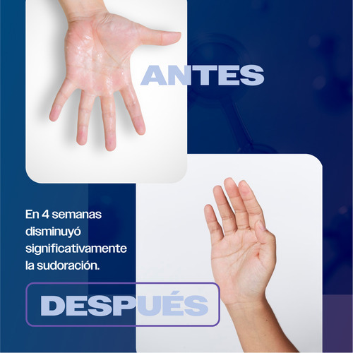 Imagen 5 de 9 de Skindry Sensitive Antitranspirante Sudoración Excesiva 20ml