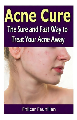 Acne Cure: The Sure And Fast Way To Treat Your Acne Away, De Faunillan, Fhilcar., Vol. 1. Editorial Createspace, Tapa Blanda En Inglés