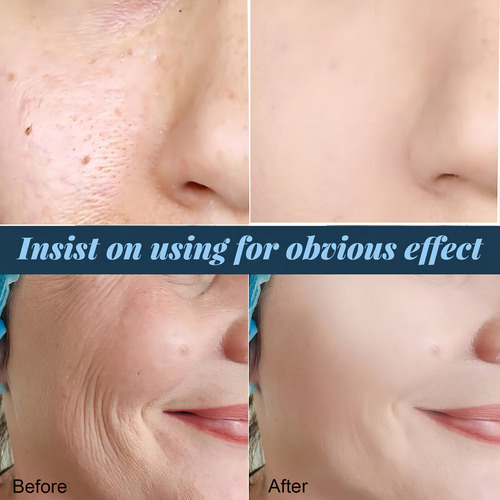 Profirm - Hilo De Proteína Soluble Coreano, Instalift Conjunto De Levantamiento De Hilos De Proteína Coreana, Reduce Las Líneas Finas Hidratan Profundamente La Piel, Hilo De Colágeno Absorbente Para