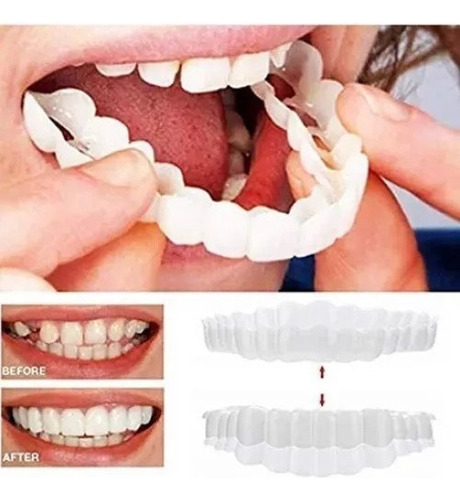 Tampa De Dente Falso Superior Encaixe No Sorriso Perfeito Em