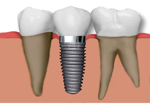 Imagen 1 de 3 de Implante Dental Straumann Con Corona De Porcelana. Belgrano