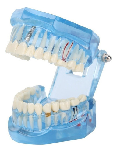 Dientes Dentales Modelo Acrílico Azul Transparente