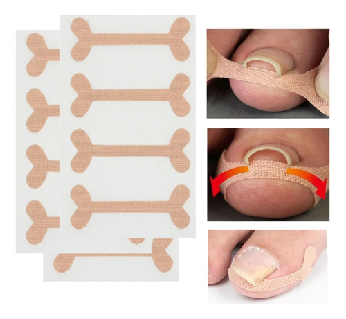 Kit Corrección Uñas Encarnadas Pie Herramienta Pedicura Lima