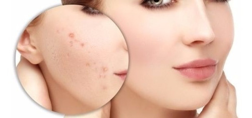 Crema Acido Salicilico Topico Rostro Facial Envio Gratis