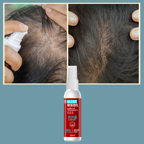 Kit Microagulhamento Dermaroller Crescimento De Barba Cabelo