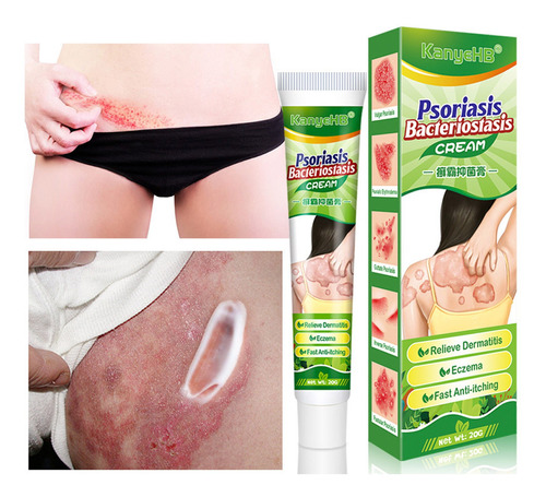 Crema Para Psoriasis, Piel, Cuidado Personal, Crema Eliminad