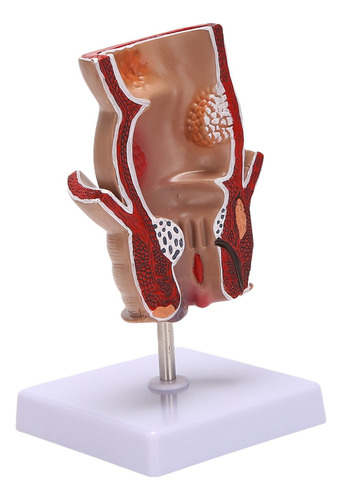 Modelo De Anatomía Modelo De Lesión De Hemorroides Rectal