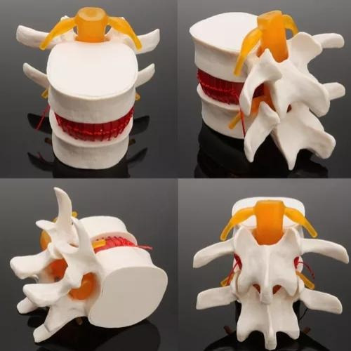 Modelo De Vértebras Lumbares: Columna Anatómica Hernia D