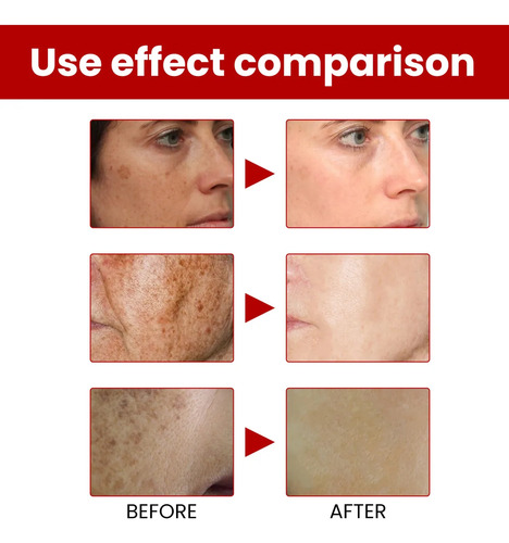 C Eliminador De Manchas Oscuras, Melasma, Pecas, Sol, Crema