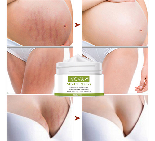 Crema Para Estrías Z 30 Ml Y Parabeno | Crema Para Estrías