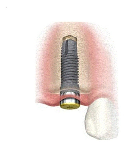 Imagen 5 de 5 de Dentista Mecanico Dental Protesis Implantes Dentales