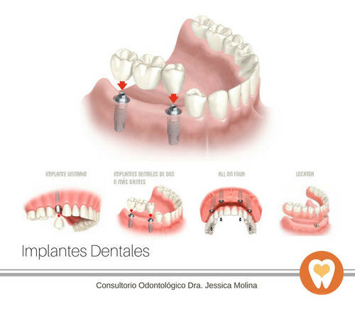 Imagen 2 de 4 de Dentista En Maldonado - Implantes - Extracciones - Urgencias