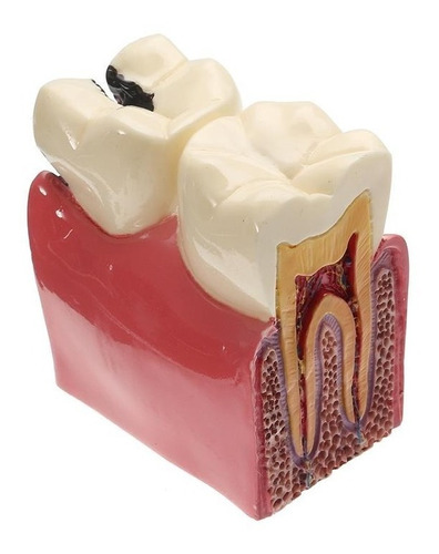 Manequim Modelo Odontológico Cárie Dente