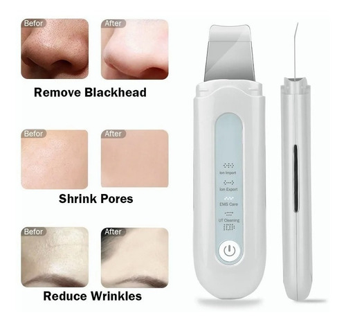 Depurador Facial De 3 Kits, Ems, Eliminación Del Acné