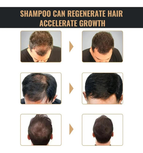 Champú Eclipta Alba Para El Cabello, Champú Eclipta Alba