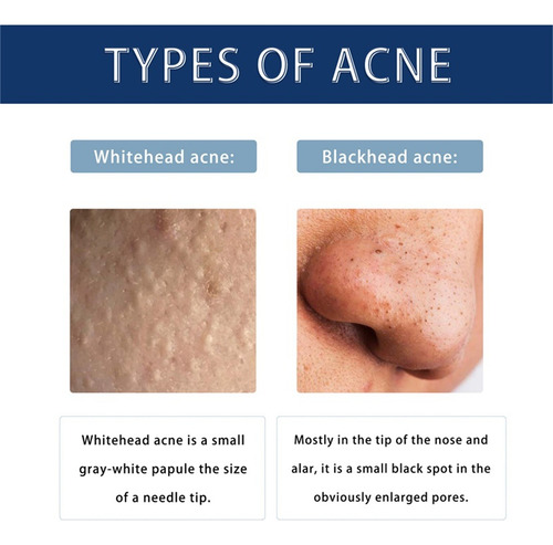 Loción Secante J Pimple De 30 Ml I Con Loción De Óxido I Par