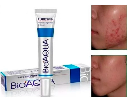 Imagen 5 de 9 de Crema Bioaqua Pureskin Elimina Acné Cicatrices Control Grasa