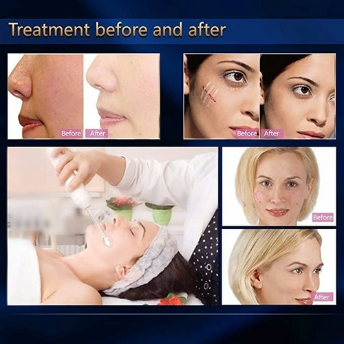 Bactericida Alta Frecuencia Portátil Acne Manchas