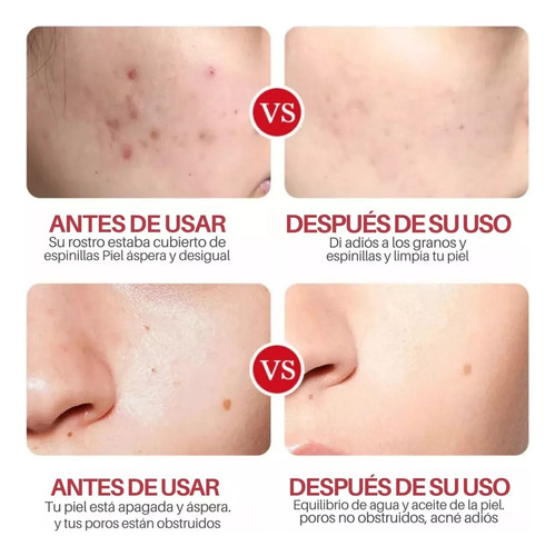 Jabón Espumoso Anti Acne Acido Salicílico + 12 Esponjas