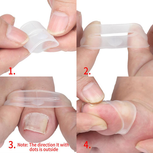 Corrección De Uñas Encarnadas Del Del Pie Cuidado De Los