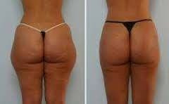 Maderoterapia Copasueca+rodillo+tabla+facial Pack 5x$38000