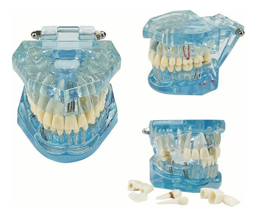 Estudio De Enfermedad Modelo De Dientes Con Implantes Dental