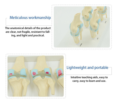 Modelo Anatómico De Articulación Degenerativa De La Rodilla