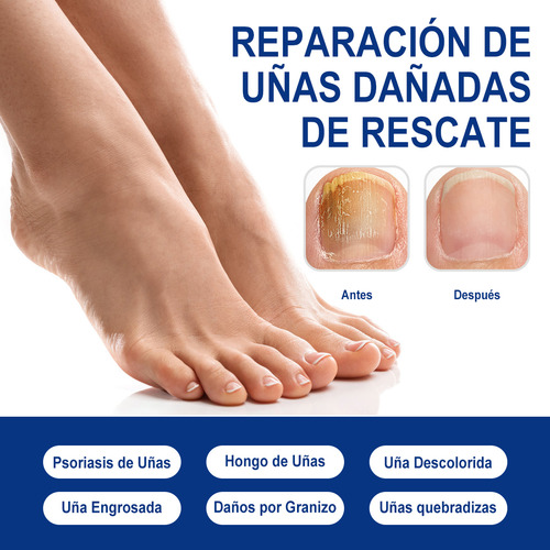 Para Eliminar Hongos En Uñas De Manos Y Piessolución, 30ml