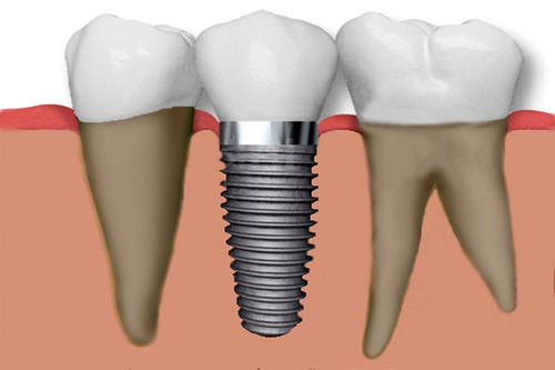 Imagen 1 de 5 de Implantes Dentales Con Pilar Y Corona De Porcelana. Belgrano