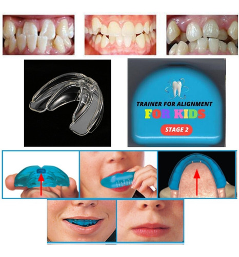 Ortodoncia Invisible Niños No Brackets Agnovedades