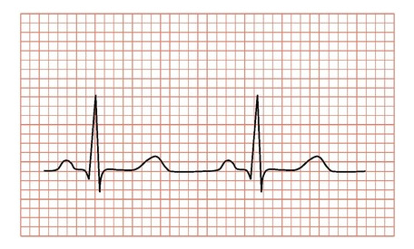 Electrocardiograma Con Evaluación Cardiológica