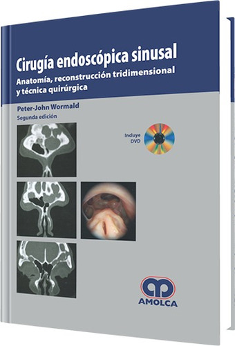 Cirugía Endoscópica Sinusal / Wormald / Amolca
