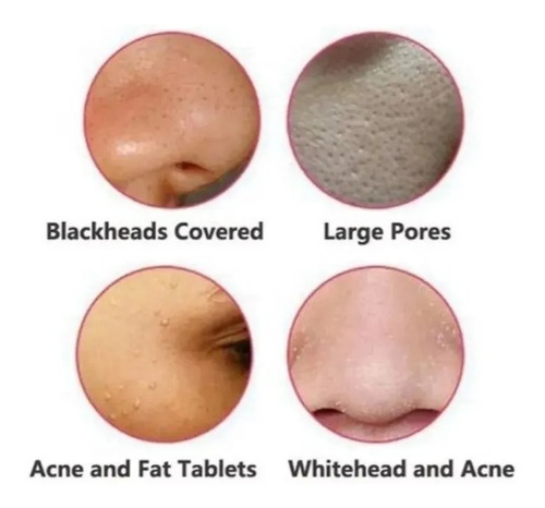 Imagen 6 de 7 de Limpiador Facial Electrico Succiona Puntos Negros Espinillas