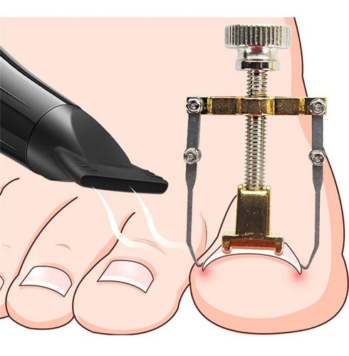 Unha Encravada Ferramenta Para Desencravar Unhas Desencravad