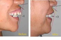 Comprar  Implantes Dentales De Promoción, Ortodoncia, Bichectomía