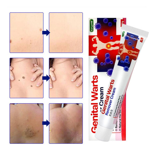 Crema Unguento Elimina Verrugas Genitales Herpes 20g