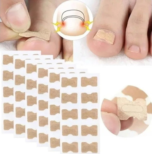 Parche Corrector De Uñas Encarnadas X 10 Unidades