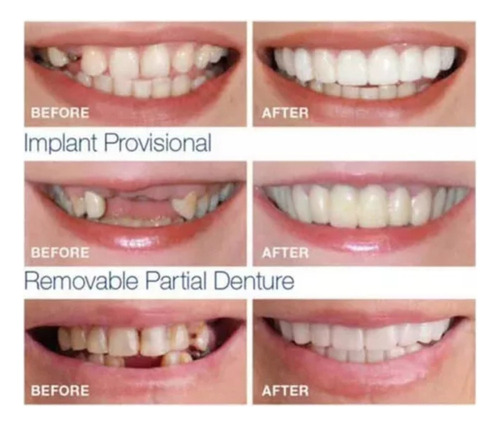 Carillas Superiores E Inferiores De Silicona Para Dientes Pe