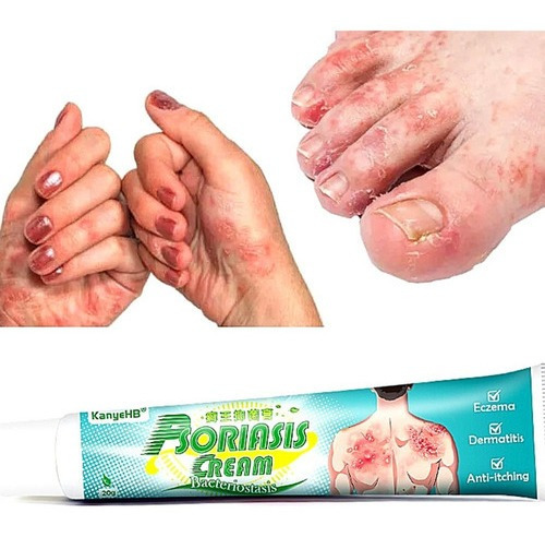 Dermatite Palpebral