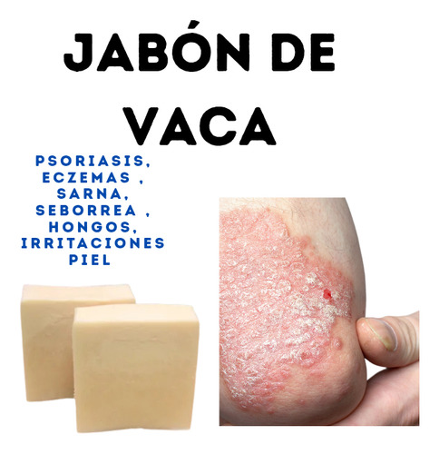 Jabón De Vaca Psoriasis Sarna Seborrea Piel Rosacea