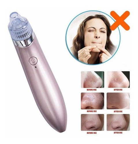 Extractor Espinillas Puntos Negros Vacuum Facial Peeling
