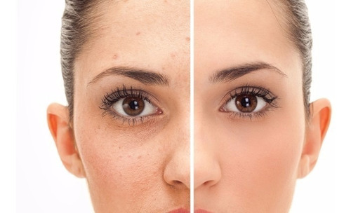 Crema Acido Salicilico Topico Rostro Facial Envio Gratis