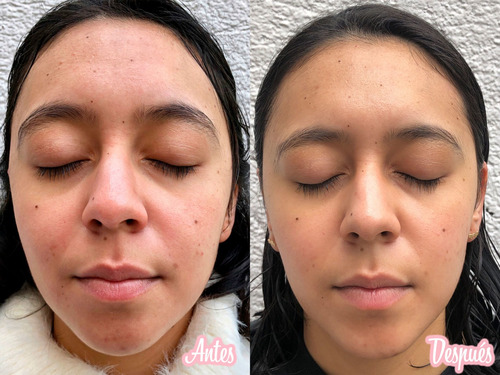 Serum Acido Hialuronico Anti-edad Vitamina C + E Arrugas