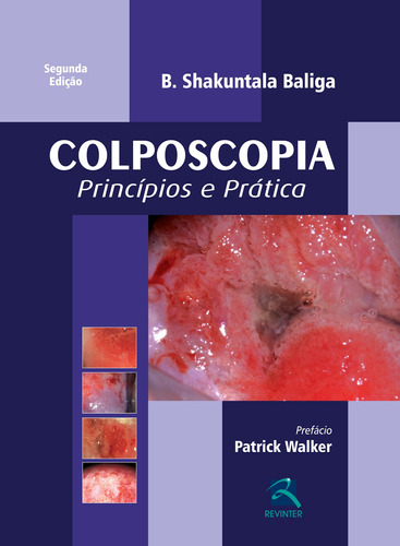 Colposcopia: Princípios E Prática, de Baliga, Shakuntala B.. Editora Thieme Revinter Publicações Ltda, capa dura em português, 2015