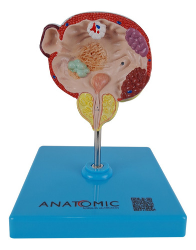Anatomia Bexiga Urinária E Próstata Com Patologias Anatomia