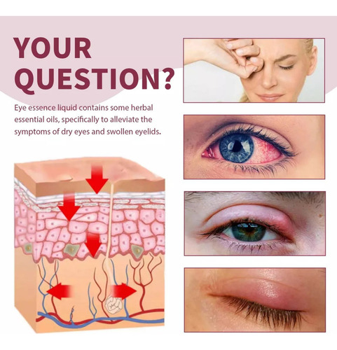 / El Sérum Calmante For Ojos Stye Alivia Las Infecciones, La